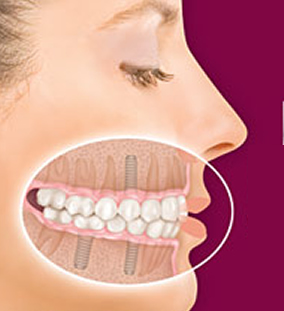 implantologie orala